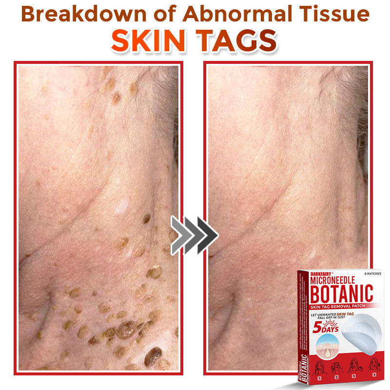✅👩⚕️ DarkFairy® MicroNeedle Botanic Skin Tag Removal Patch 🇺🇸 Made in the USA
