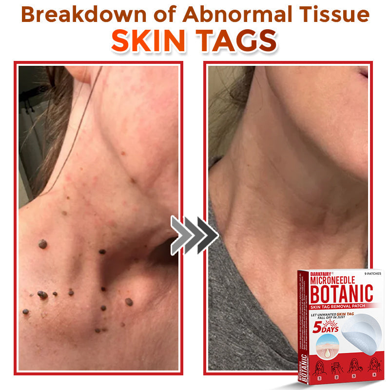 ✅👩⚕️ DarkFairy® MicroNeedle Botanic Skin Tag Removal Patch 🇺🇸 Made in the USA