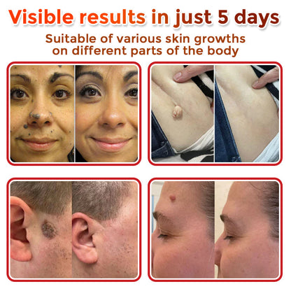 ✅👩‍⚕️ DarkFairy® MicroNeedle Botanic Skin Tag Removal Patch 🇺🇸 Made in the USA